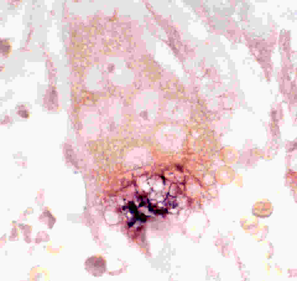 An osteoclast with multiple nuclei has been probed for mRNA of the chemokine CCL9 (MIP1-γ). Abundant mRNA is seen as dark purple label. Nuclei are the pale areas in the cytoplasm, and several contain darker nucleoli. (see Yang et al. 2006. Blood 107(6):2262-2270.).