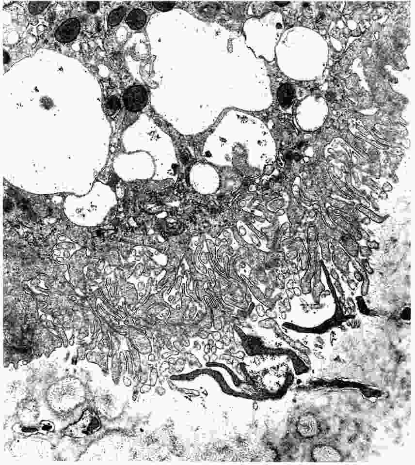 The osteoclast ruffled border. This TEM image shows the extremely complex form of an osteoclast actively resorbing bone. Several large vacuoles are visible. The light colored area below is bone, to which the osteoclast is attached and is actively resorbing. The extremely high traffic of membrane-bounded vesicles out of and back into the osteoclast is a complex process. In the osteopetrotic ia/ia rat, a mutation in the Plekhm1 gene prevents the formation of a ruffled border and causes a secretory defect. (See Van Wesenbeeck et al., 2007. J Clinical Investigation 177(4):919-930).