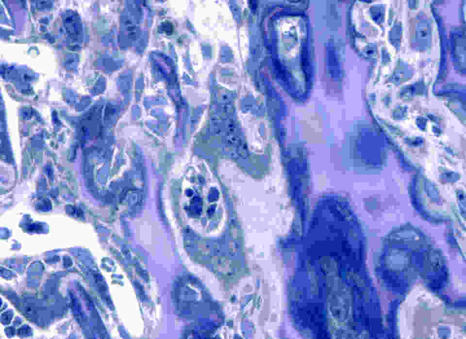 Osteopetrosis is a genetic condition in which deficient bone resorption by osteoclasts results in a sclerotic skeleton. In the op/op rat, osteoclasts are abundant but non-functional. In what should be the marrow space, instead there is mainly sclerotic bone which has never been remodeled. It appears as dark blue surrounding pinkish cartilage cores. Efforts to map the genetic lesion in this model are ongoing. (see B. Perdu et al. 2009. Calcified Tissue International 84(5):355-60).