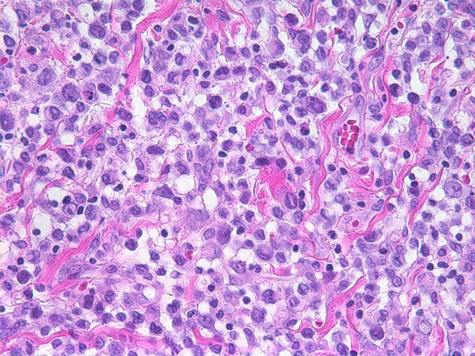 ALK Anaplastic Large cell Lymphoma