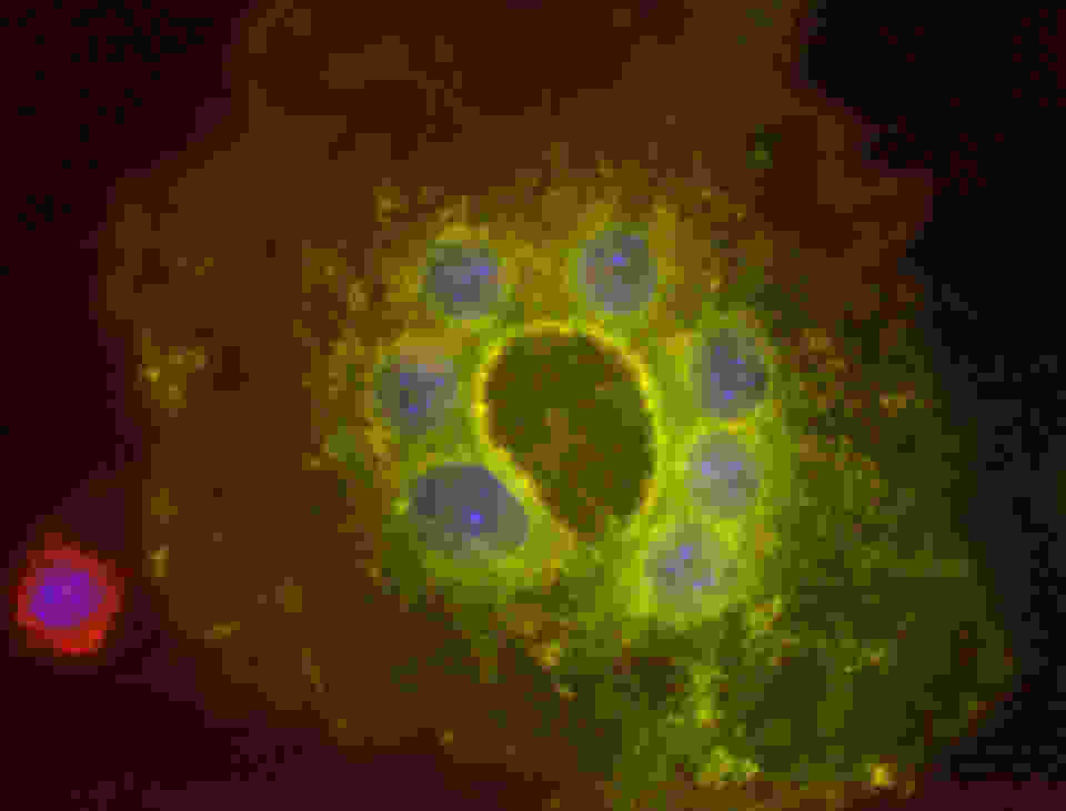 Osteoclast formed from red and green fluorescent precursors. Bone marrow precursor cells from two mice, one expressing dtTomato red fluorescent protein and one expressing eGFP, were mixed in culture. Following 4 days of treatment with CSF-1 and RANKL, the mononuclear precursors fused to form the large, multinucleated osteoclast. The combination of red + green fluorescence gives the yellow fluorescence. Nuclei stained blue with DAPI.