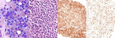 Diffuse large cell lymphoma