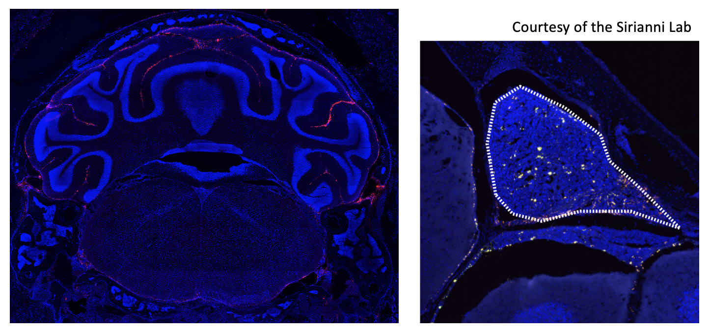 nanoparticles in subarachnoid space