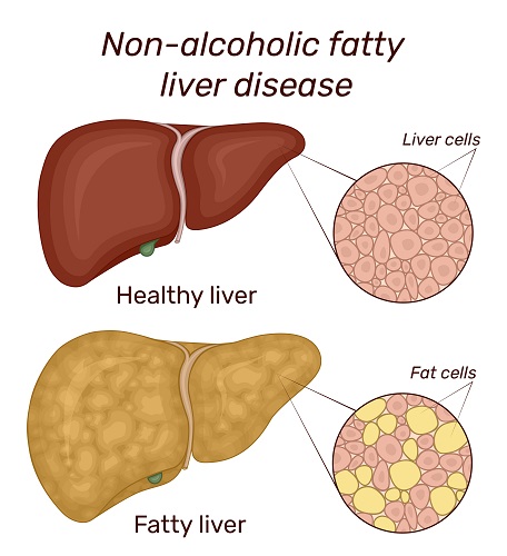 non-alchoholic-fatty-liver-disease.jpg