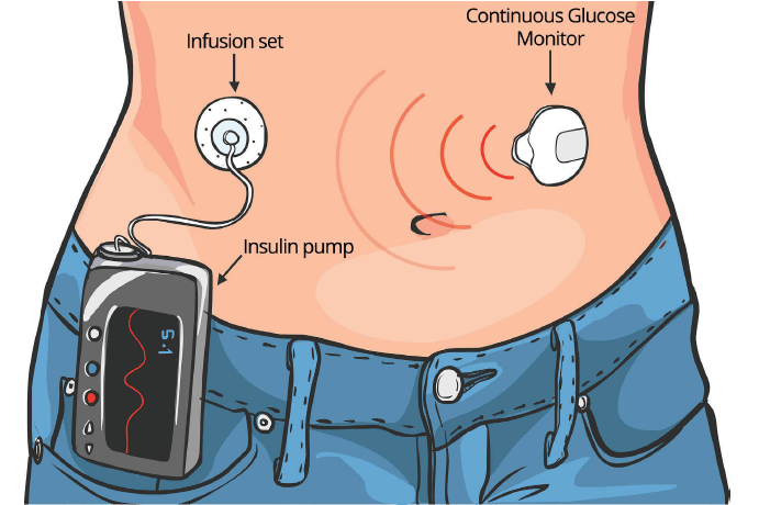Insulin pump therapy support