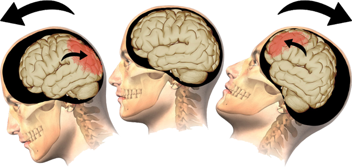 Brain Injury Types