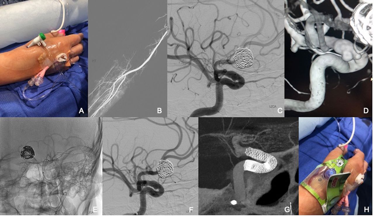 Distal radial access in the anatomical snuffbos for neurointerventions