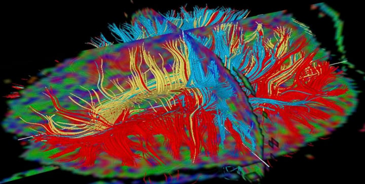 IPAC brain image