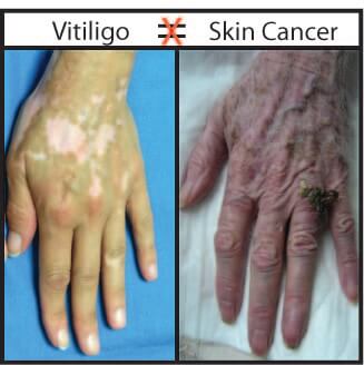 I have vitiligo, will I get skin cancer?