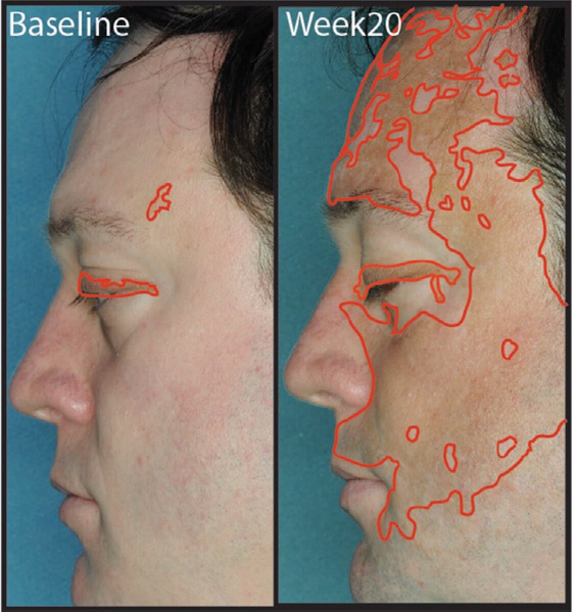 Jakafi treatment result for vitiligo