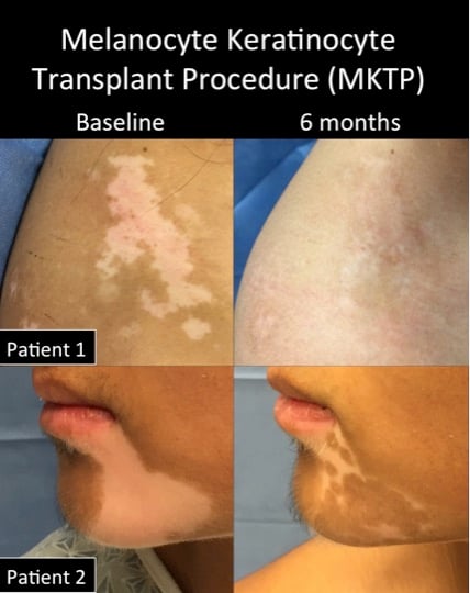 MKTP before-after