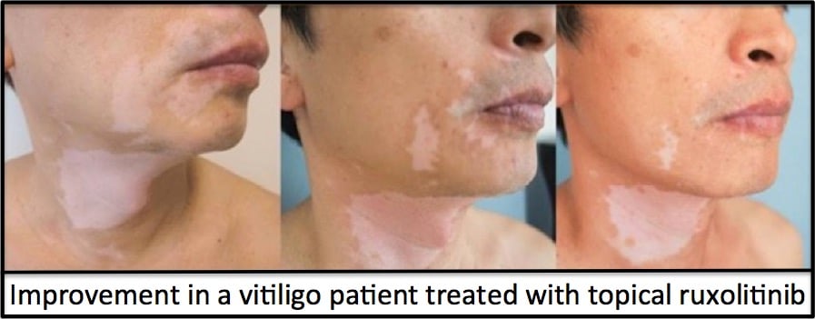 topical ruxolitinib for vitiligo