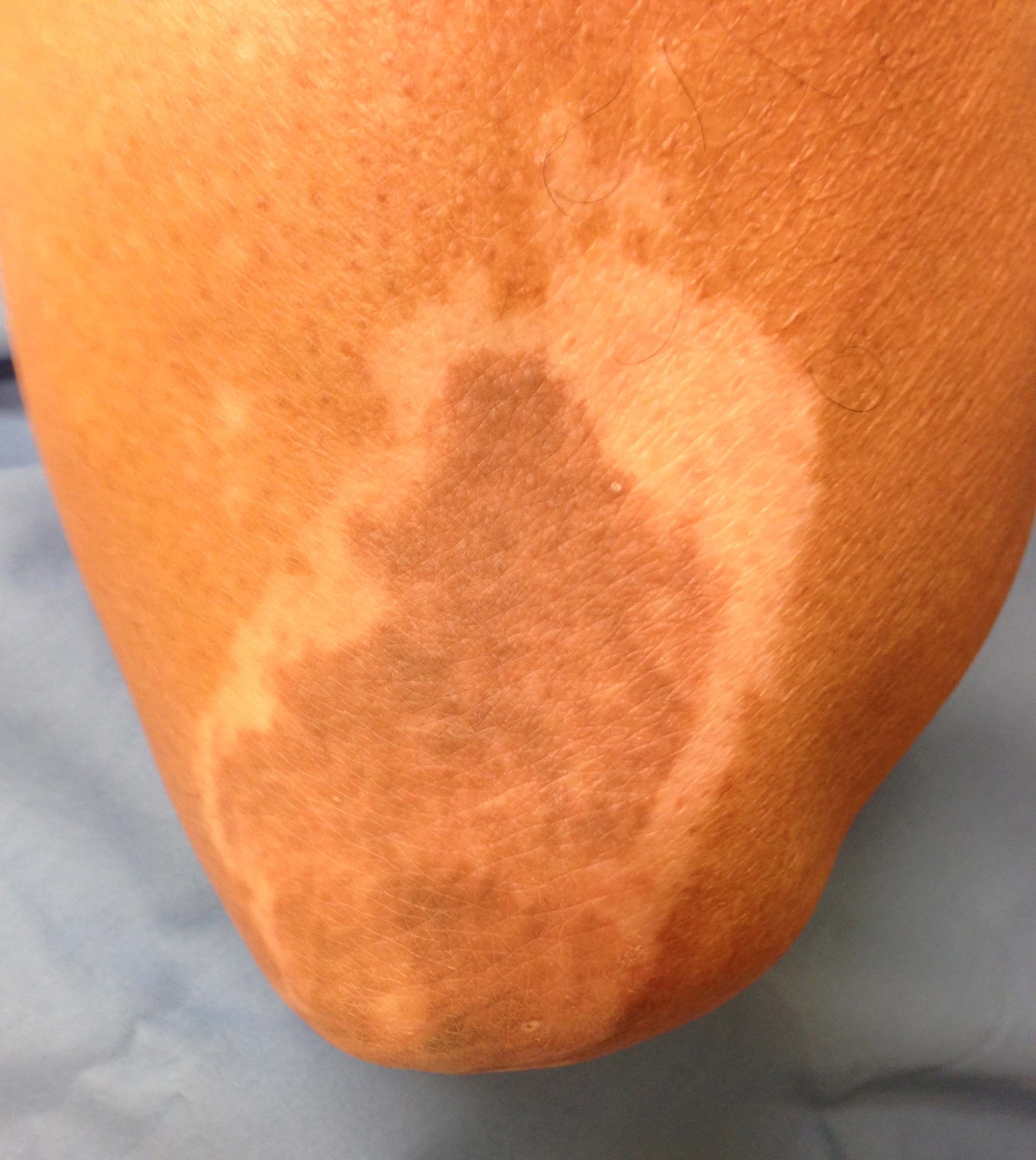 Tattoo vitiligo skin color