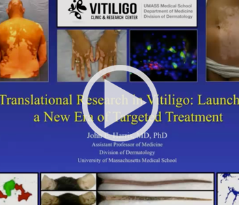 Translational Research in Vitiligo Video