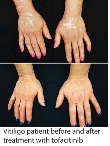 Tofacitinib treatment of vitiligo